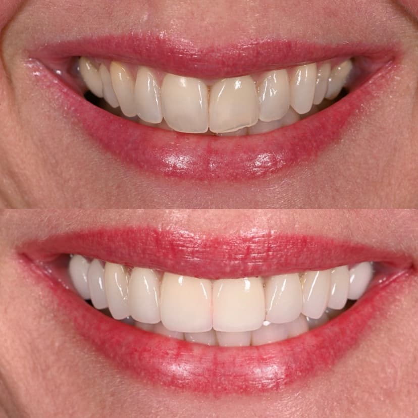 Before and after smile transformation at Genesis by Dr. Ben Reyhani