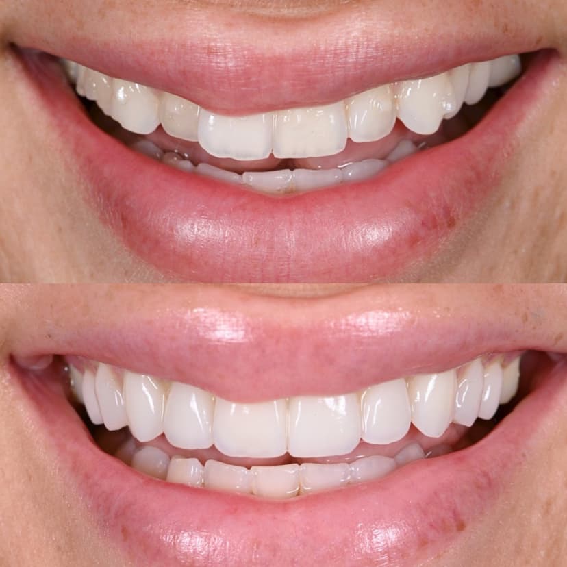 Before and after smile transformation at Genesis by Dr. Ben Reyhani