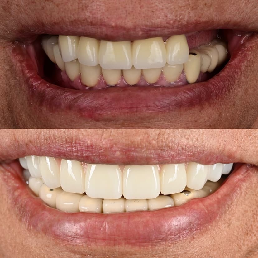 Before and after smile transformation at Genesis by Dr. Ben Reyhani