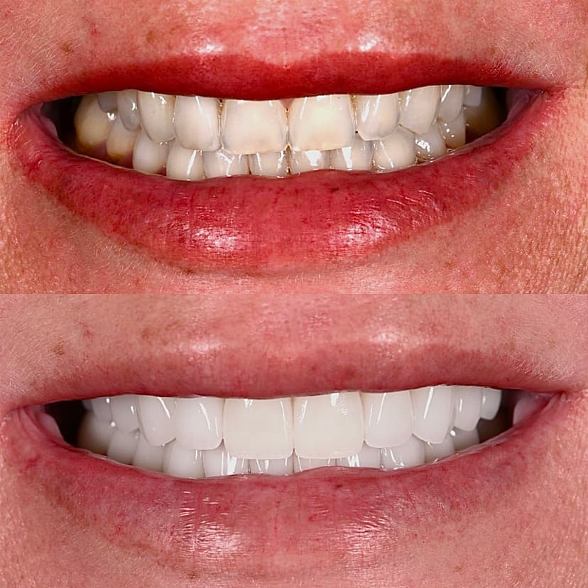 Before and after smile transformation at Genesis by Dr. Ben Reyhani