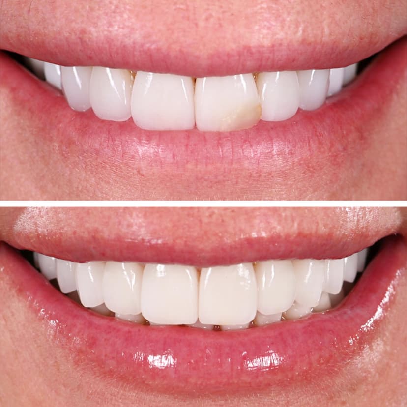 Before and after smile transformation at Genesis by Dr. Ben Reyhani