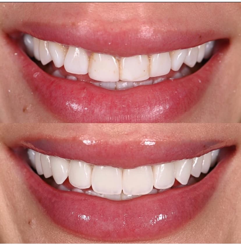 Before and after smile transformation at Genesis by Dr. Ben Reyhani