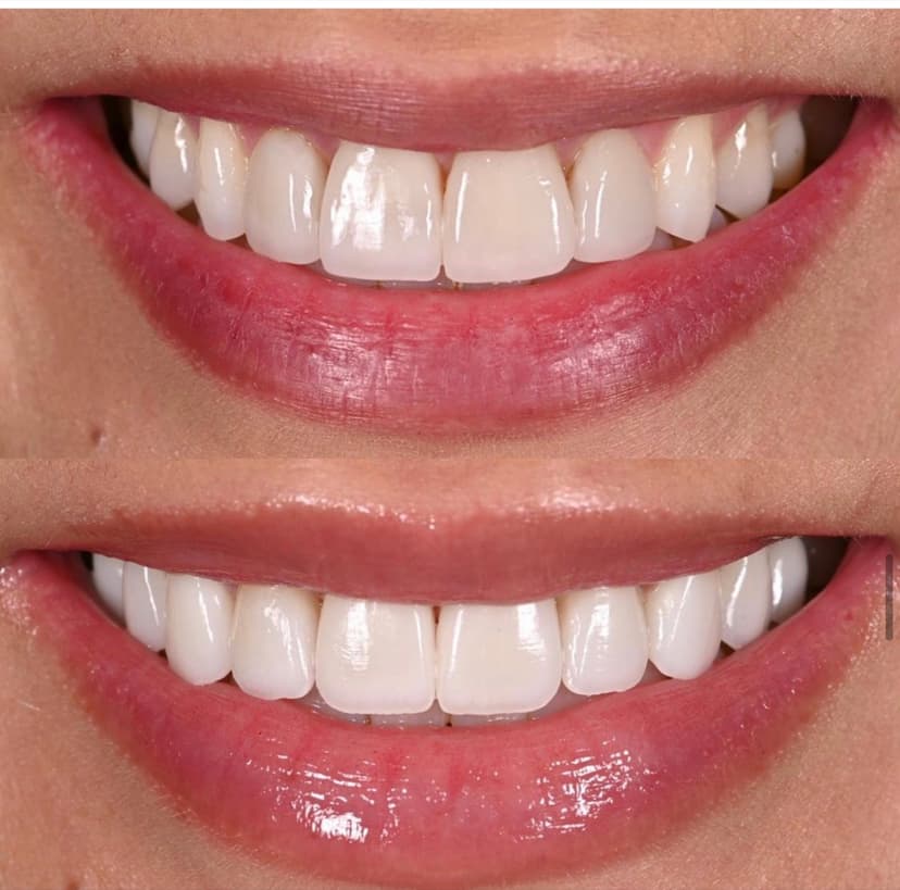 Before and after smile transformation at Genesis by Dr. Ben Reyhani