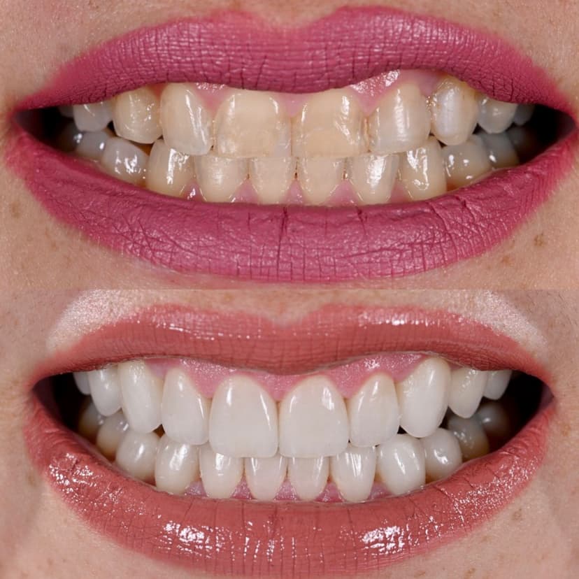Before and after smile transformation at Genesis by Dr. Ben Reyhani