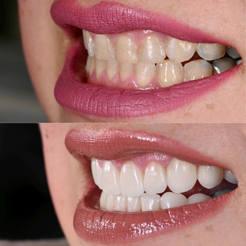 Before and after smile transformation at Genesis by Dr. Ben Reyhani