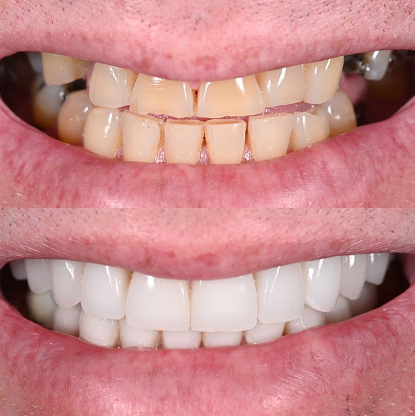 Before and after smile transformation at Genesis by Dr. Ben Reyhani