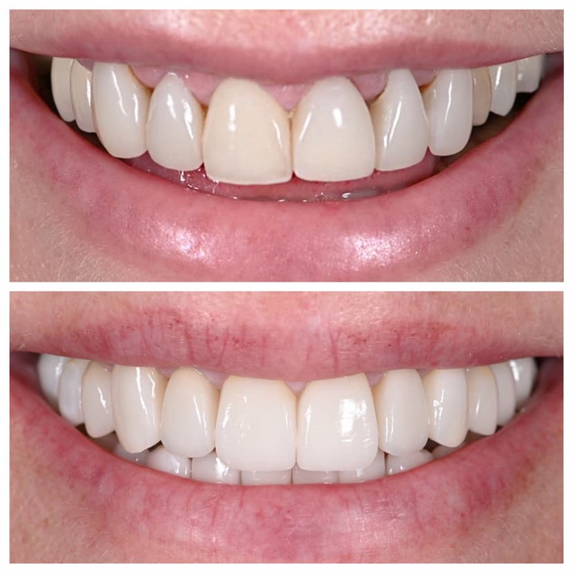 Before and after smile transformation at Genesis by Dr. Ben Reyhani