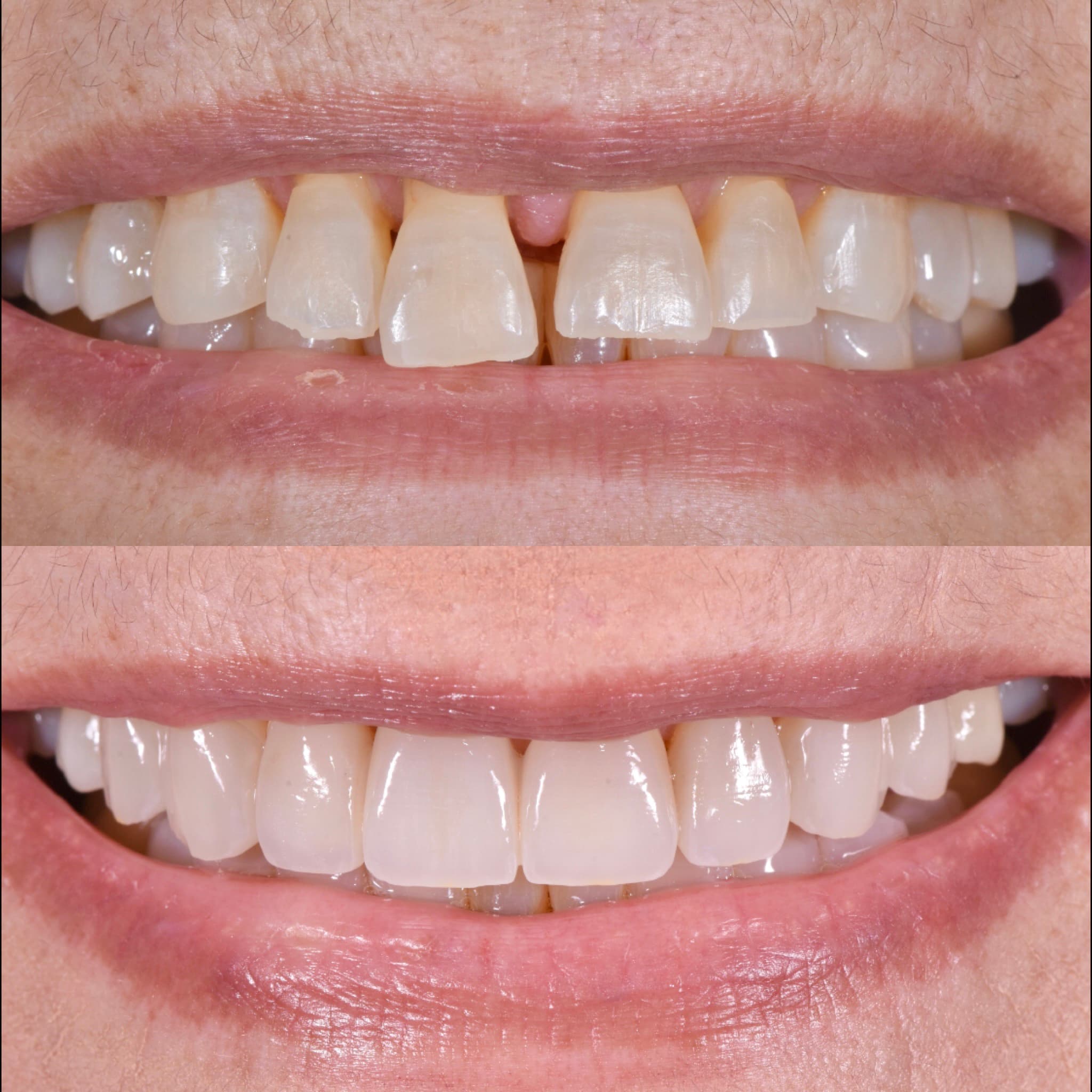 Porcelain Veneers before and after