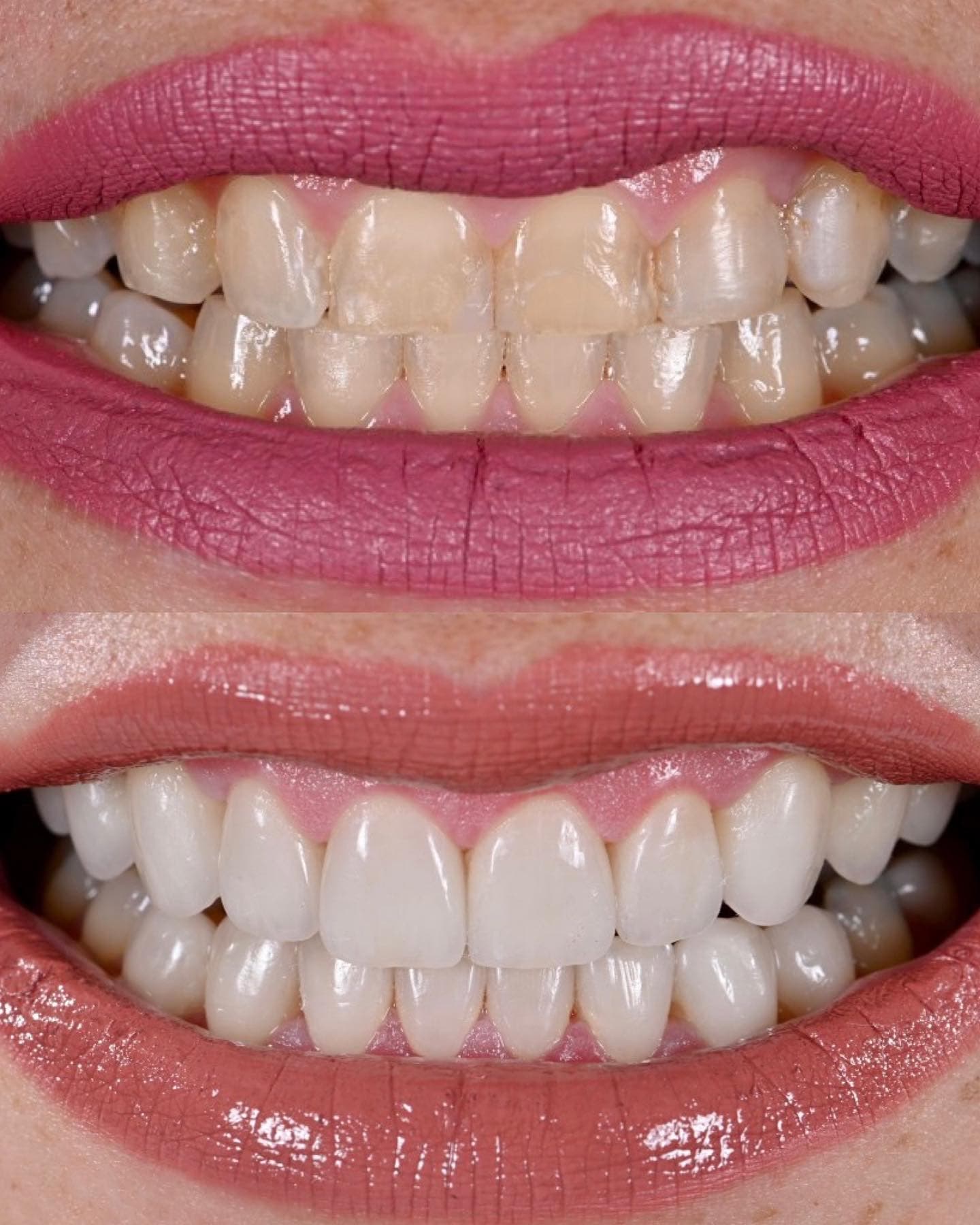 Smile Makeover before and after