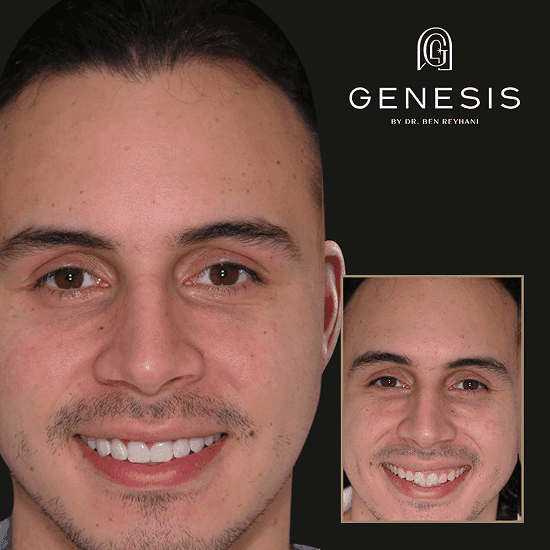 Before and after veneers smile transformation at Genesis by Dr. Ben Reyhani