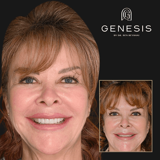 Before and after dental restoration smile transformation at Genesis by Dr. Ben Reyhani