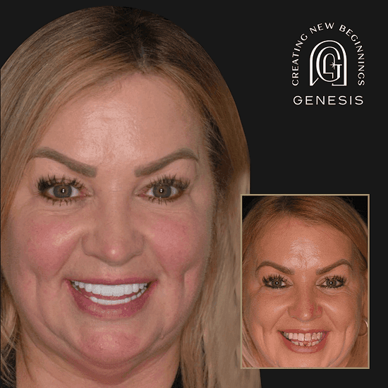 Before and after cosmetic treatment smile transformation at Genesis by Dr. Ben Reyhani