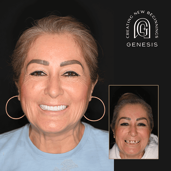 Before and after dental implants smile transformation at Genesis by Dr. Ben Reyhani