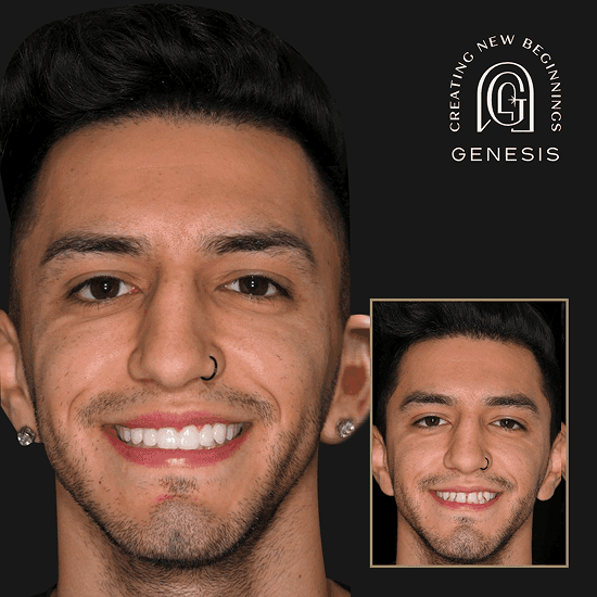 Before and after full smile makeover transformation at Genesis by Dr. Ben Reyhani